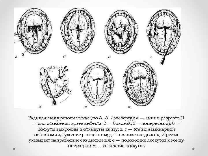 Радикальная уранопластика (по А. А. Лимбергу): a — линии разрезов (1 — для освежения