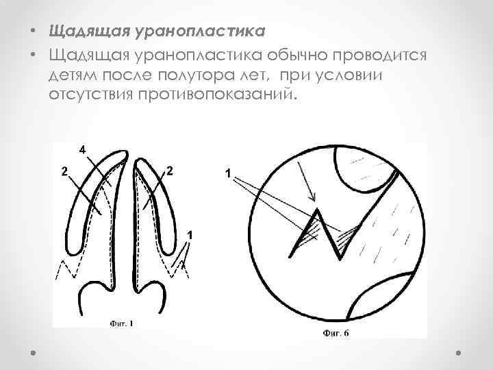  • Щадящая уранопластика обычно проводится детям после полутора лет, при условии отсутствия противопоказаний.