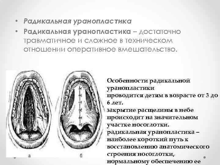  • Радикальная уранопластика – достаточно травматичное и сложное в техническом отношении оперативное вмешательство.