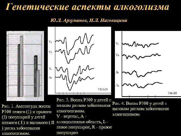 Генетические аспекты алкоголизма Ю. Л. Арзуманов, И. Л. Наговицина Рис. 3. Волна Р 300