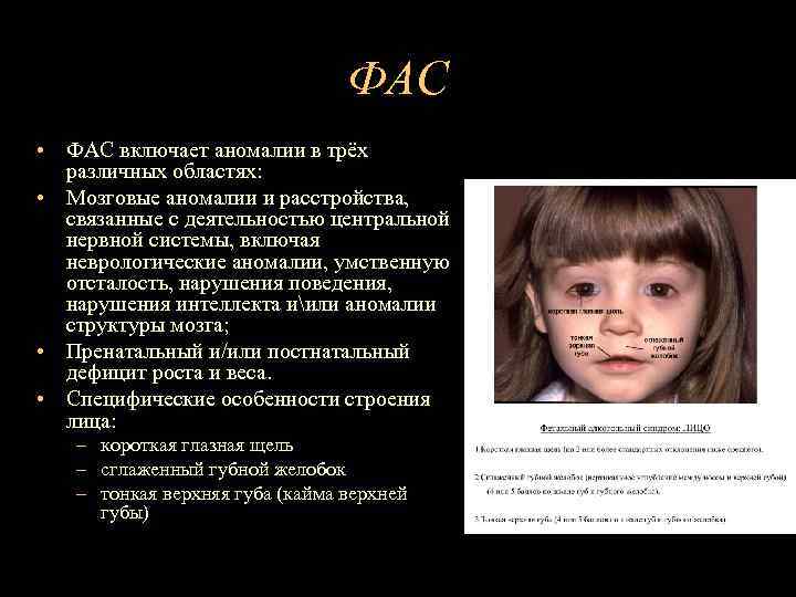 ФАС • ФАС включает аномалии в трёх различных областях: • Мозговые аномалии и расстройства,