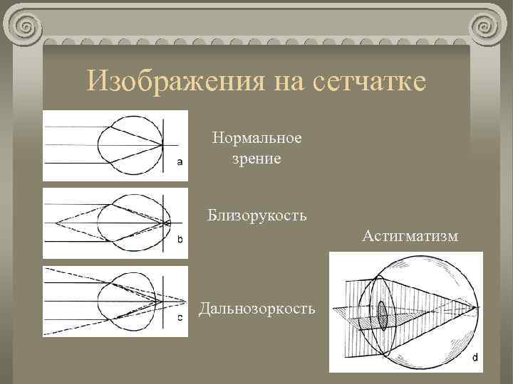 Изображения на сетчатке Нормальное зрение Близорукость Астигматизм Дальнозоркость 