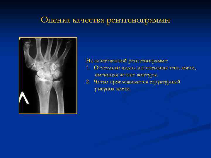 Оценка качества рентгенограммы На качественной рентгенограмме: 1. Отчетливо видна интенсивная тень кости, имеющая четкие