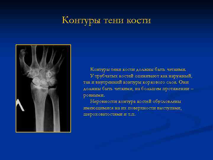 Контуры тени кости должны быть четкими. У трубчатых костей оценивают как наружный, так и