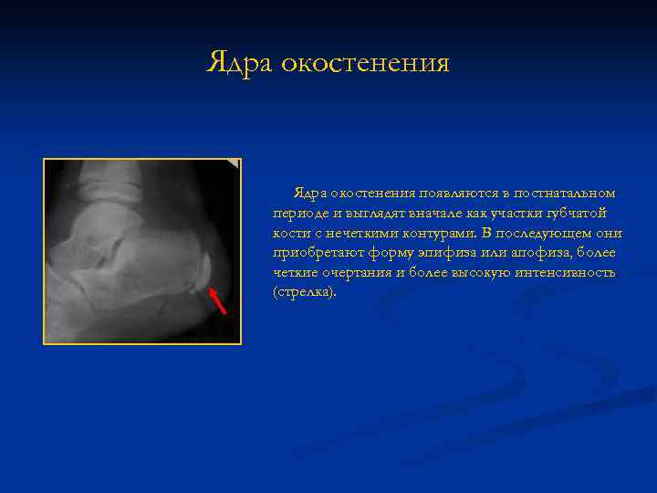 Окостенение головки бедренной кости. Ядра окостенения пяточной кости у детей. Ядра окостенения головок бедренных костей. Ядра окостенения головок. Ядро окостенения эпифиза.