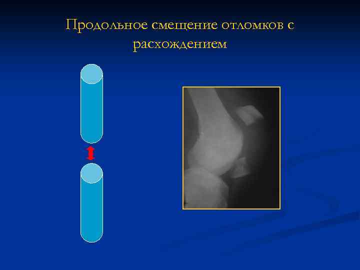 Продольное смещение отломков с расхождением 