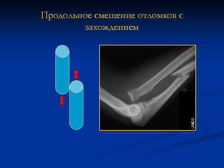 Продольное смещение отломков с захождением 