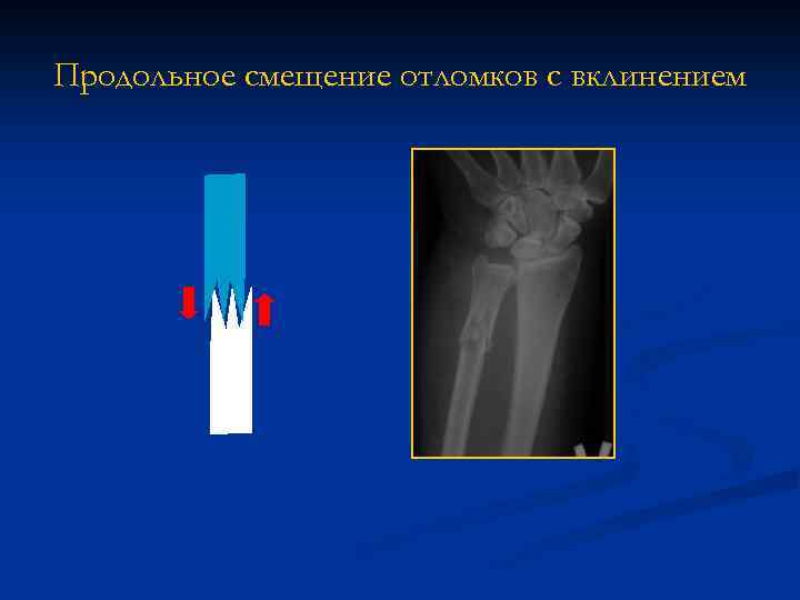 Продольное смещение отломков с вклинением 