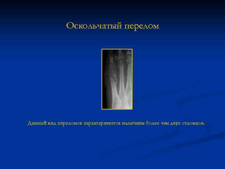 Оскольчатый перелом Данный вид переломов характеризуется наличием более чем двух отломков. 