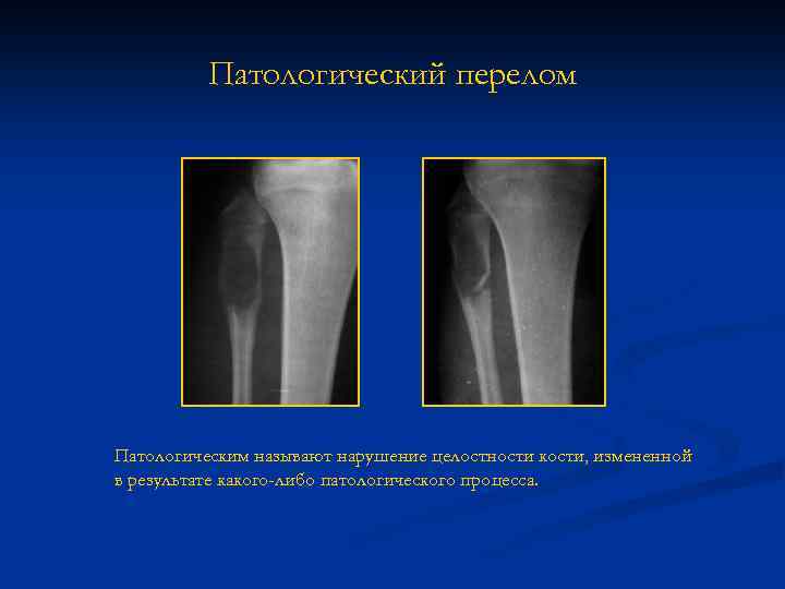 Патологический перелом. Травматические и патологические переломы. Патологические переломы костей. Переломы костей травматические и патологические.