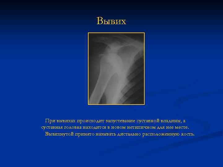 Вывих При вывихах происходит запустевание суставной впадины, а суставная головка находится в новом нетипичном