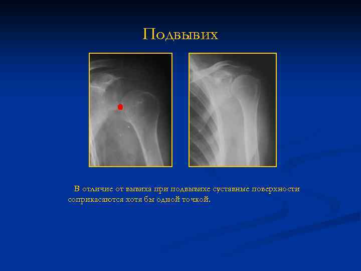 Подвывих В отличие от вывиха при подвывихе суставные поверхности соприкасаются хотя бы одной точкой.