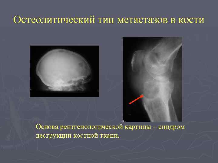 Остеолитический тип метастазов в кости Основа рентгенологической картины – синдром деструкции костной ткани. 