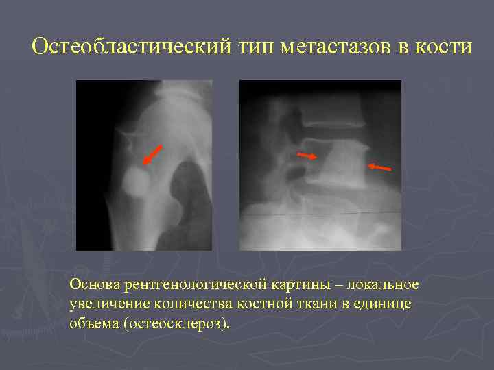 Очаговые изменения костей. Остеобластические метастазы в костях рентген. Остеобластические метастазы в кости таза рентген. Остеобластические метастазы к кости рентген. Остеобластические метастазы в кости рентгенограмма.