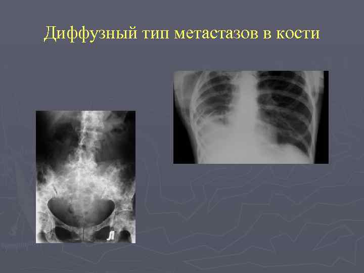 Диффузный тип метастазов в кости 