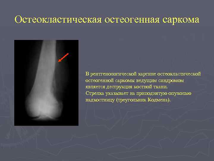 Остеокластическая остеогенная саркома В рентгенологической картине остеокластической остеогенной саркомы ведущим синдромом является деструкция костной