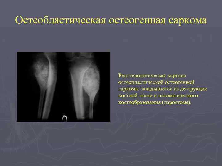 Остеобластическая остеогенная саркома Рентгенологическая картина остеопластической остеогенной саркомы складывается из деструкции костной ткани и