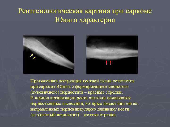 Рентгенологическая картина при саркоме Юинга характерна Протяженная деструкция костной ткани сочетается при саркоме Юинга