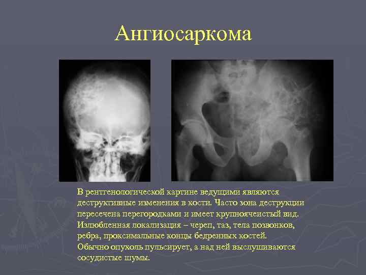 Ангиосаркома В рентгенологической картине ведущими являются деструктивные изменения в кости. Часто зона деструкции пересечена