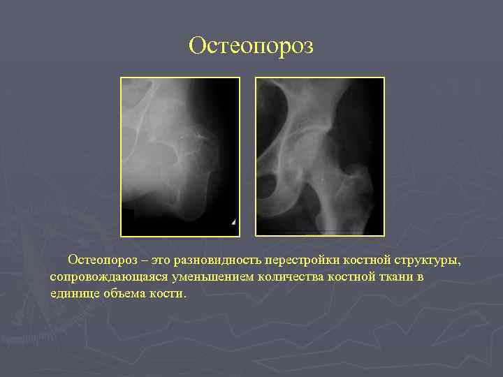 Остеопороз – это разновидность перестройки костной структуры, сопровождающаяся уменьшением количества костной ткани в единице