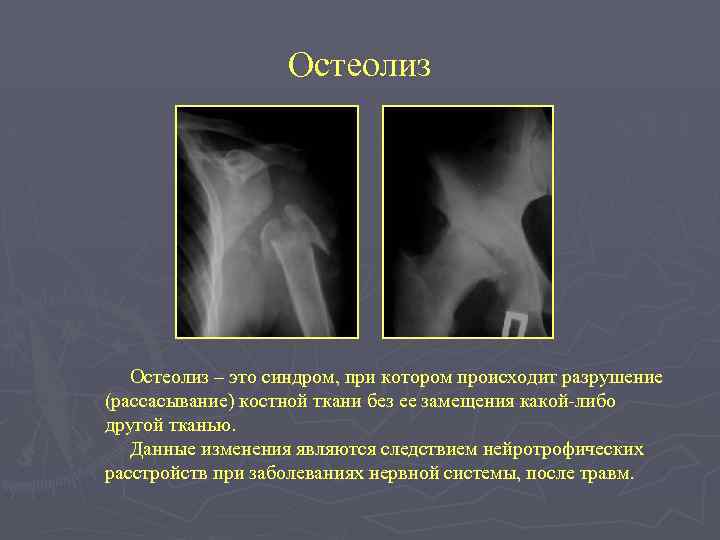 Остеолиз – это синдром, при котором происходит разрушение (рассасывание) костной ткани без ее замещения