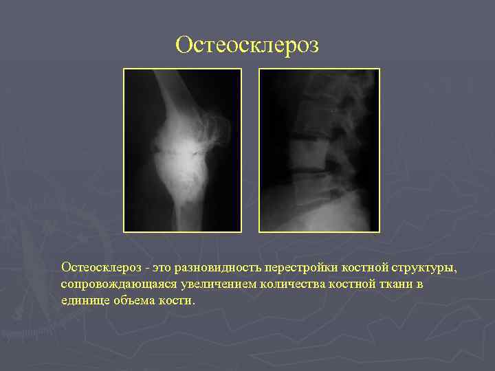 Остеосклероз - это разновидность перестройки костной структуры, сопровождающаяся увеличением количества костной ткани в единице