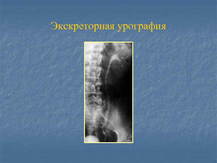 Экскреторная урография 