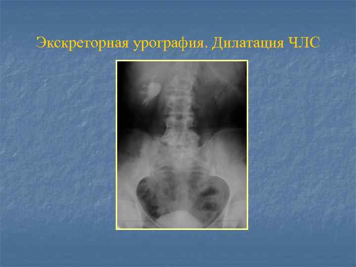 Экскреторная урография. Дилатация ЧЛС 