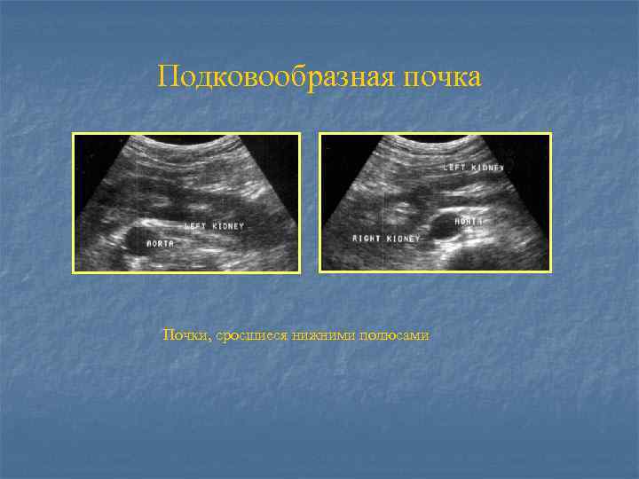 Подковообразная почка Почки, сросшиеся нижними полюсами 