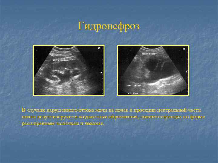 Гидронефроз В случаях нарушенного оттока мочи из почек в проекции центральной части почки визуализируются