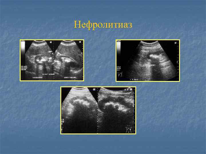 Нефролитиаз 