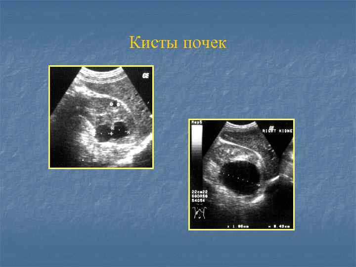 Кисты почек 