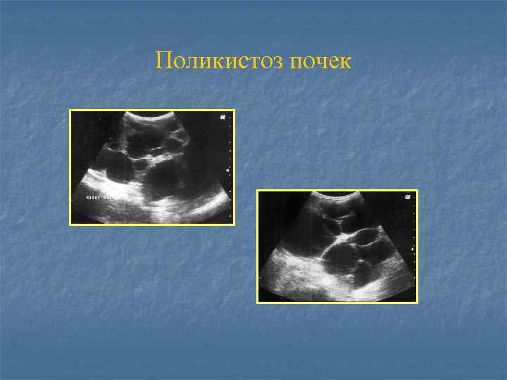 Поликистоз почек 