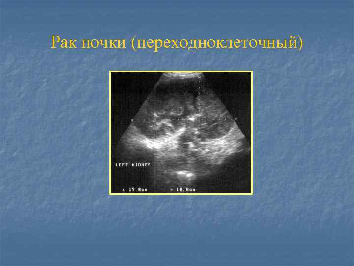 Рак почки (переходноклеточный) 