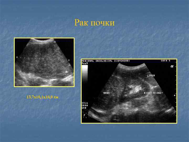 Рак почки 13, 7 х10, 1 х10, 0 см 