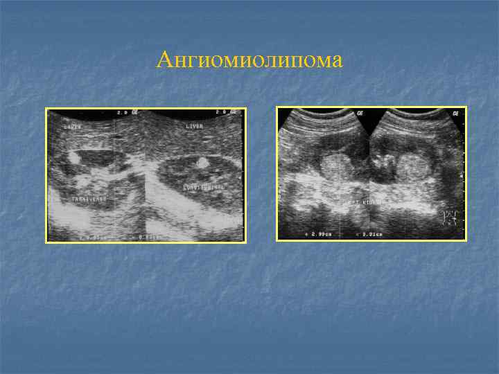 Ангиомиолипома 
