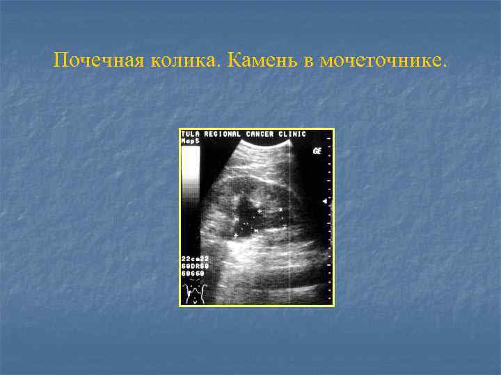 Почечная колика. Камень в мочеточнике. 