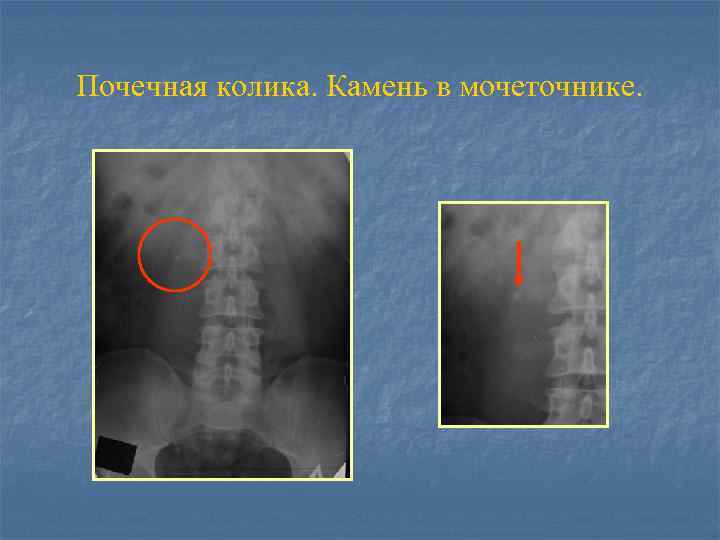 Почечная колика. Камень в мочеточнике. 
