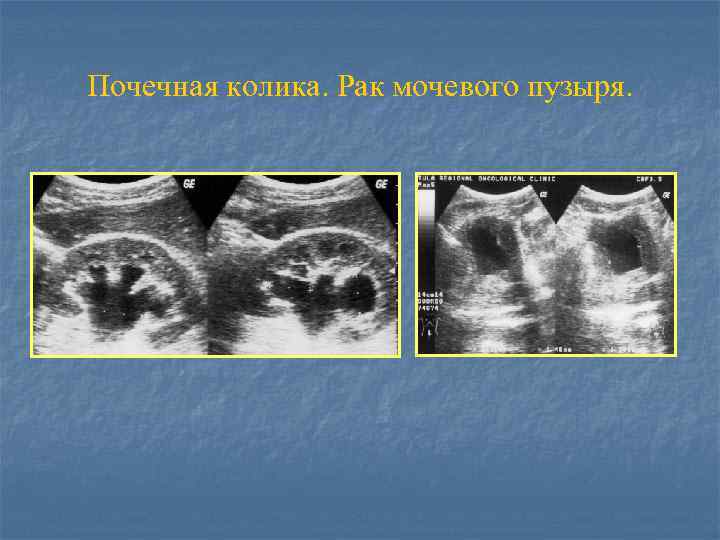 Почечная колика. Рак мочевого пузыря. 