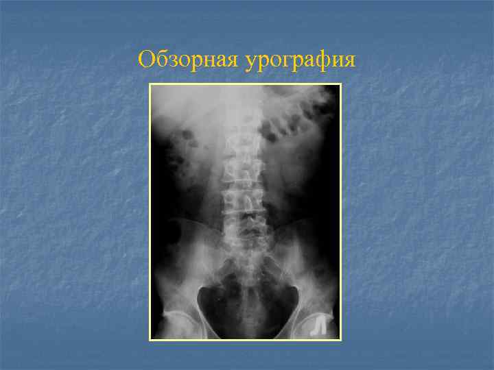 Обзорная урография 