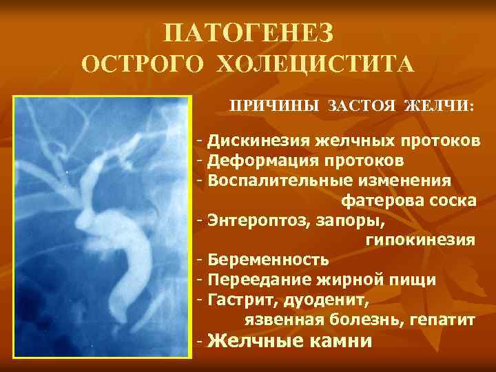 ПАТОГЕНЕЗ ОСТРОГО ХОЛЕЦИСТИТА ПРИЧИНЫ ЗАСТОЯ ЖЕЛЧИ: - Дискинезия желчных протоков - Деформация протоков -