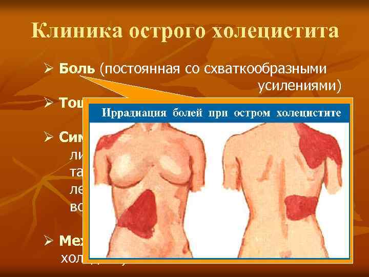 Клиника острого холецистита Ø Боль (постоянная со схваткообразными усилениями) Ø Тошнота, рвота Ø Симптомы