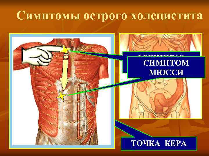 Для эхографической картины острого холецистита характерно тест