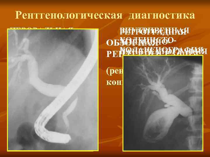 Рентгенологическая диагностика ПЕРОРАЛЬНАЯ ХОЛЕЦИСТОХОЛАНГИОГРАФИЯ ВНУТРИВЕННАЯ РЕТРОГРАДНАЯ ХОЛЕЦИСТОХОЛАНГИООБЗОРНАЯ ХОЛАНГИОГРАФИЯ ПАНКРЕАТОГРАФИЯ РЕНТГЕНОГРАФИЯ (рентгеноконтрастные конкременты) 