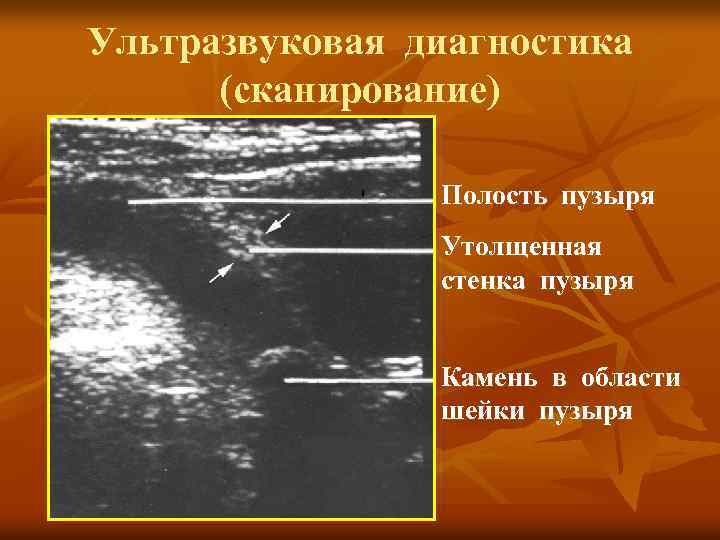 Ультразвуковая диагностика (сканирование) Полость пузыря Утолщенная стенка пузыря Камень в области шейки пузыря 