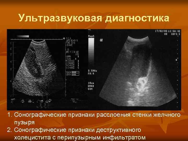 Ультразвуковая диагностика 1. Сонографические признаки расслоения стенки желчного пузыря 2. Сонографические признаки деструктивного холецистита