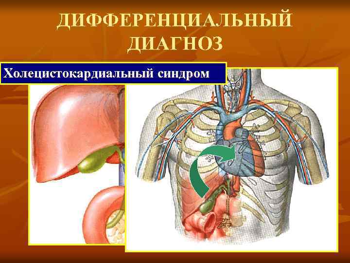 ДИФФЕРЕНЦИАЛЬНЫЙ ДИАГНОЗ Холецистокардиальный синдром 