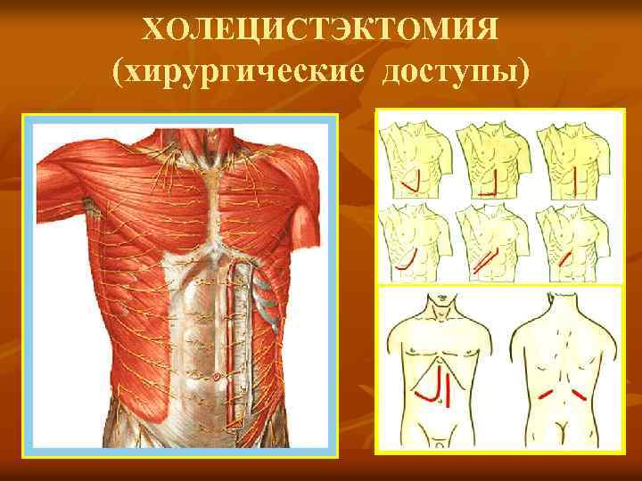 ХОЛЕЦИСТЭКТОМИЯ (хирургические доступы) 