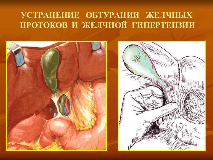 УСТРАНЕНИЕ ОБТУРАЦИИ ЖЕЛЧНЫХ ПРОТОКОВ И ЖЕЛЧНОЙ ГИПЕРТЕНЗИИ 
