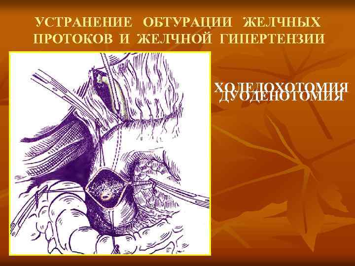 УСТРАНЕНИЕ ОБТУРАЦИИ ЖЕЛЧНЫХ ПРОТОКОВ И ЖЕЛЧНОЙ ГИПЕРТЕНЗИИ ХОЛЕДОХОТОМИЯ ДУОДЕНОТОМИЯ 